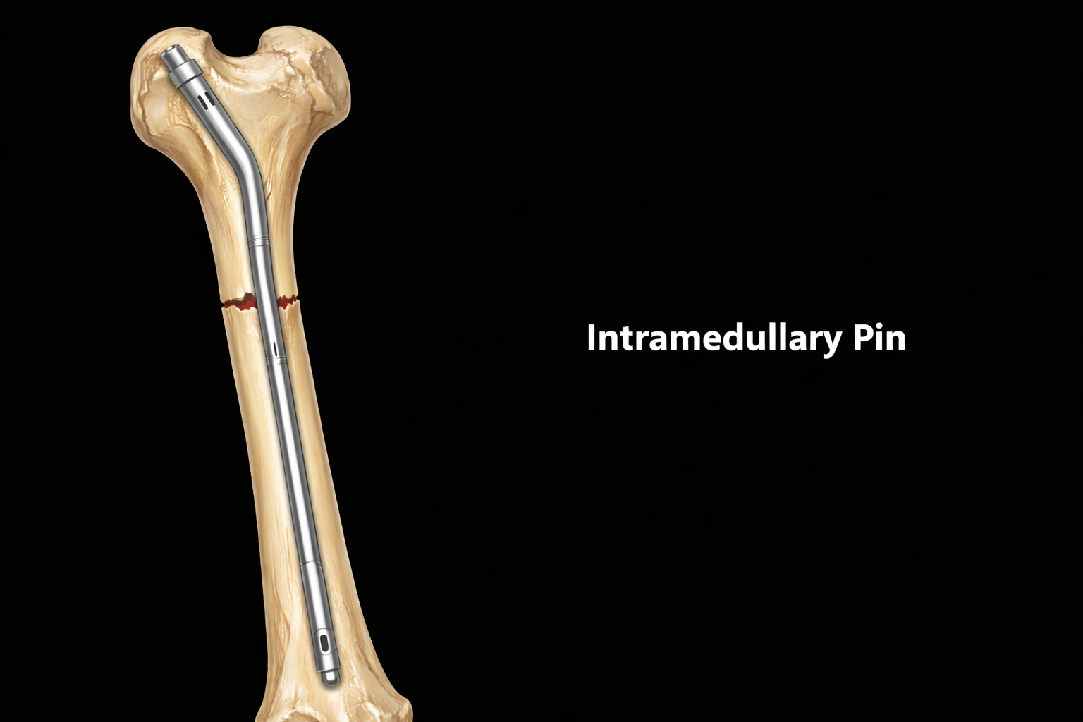 Intramedullary Pin